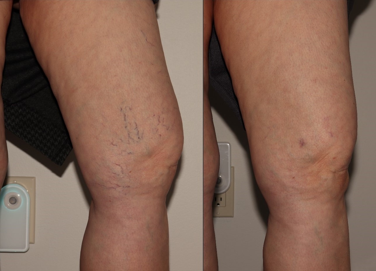 Laser Vein Removal - Discovery Laser Skin Care Clinic