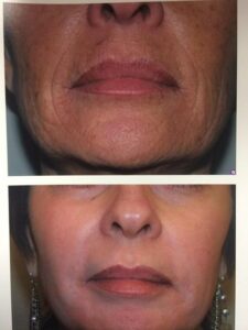 fractional laser before and after results