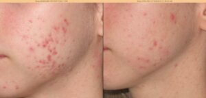 fractional laser before and after results acne scars